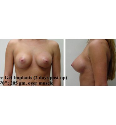 Breast Implants Over Muscle After